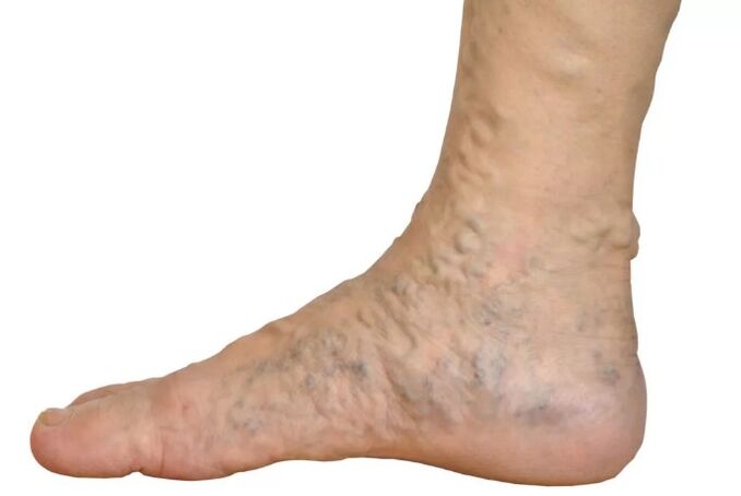 Veen's diseases on the legs