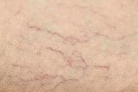 Vascular stars