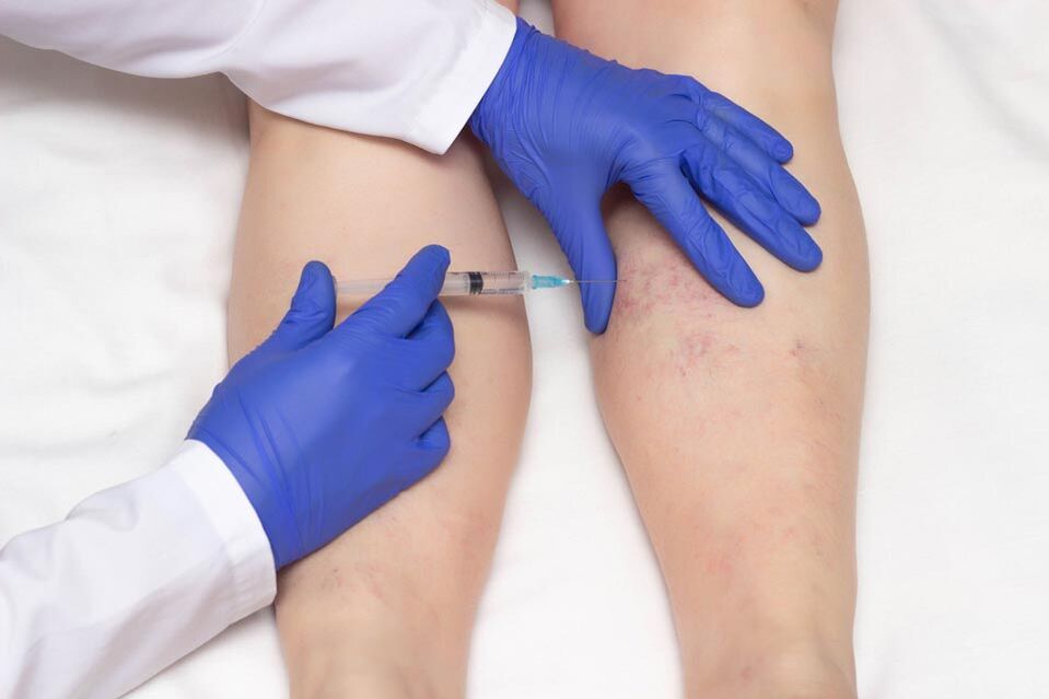 Sclerotherapy is a method of treating varicose veins