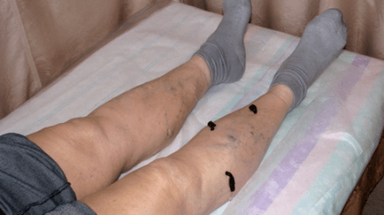 treatment of varicose veins with leeches