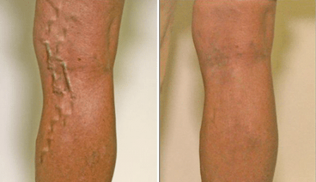 varicose veins at stages 1 and 3 of development