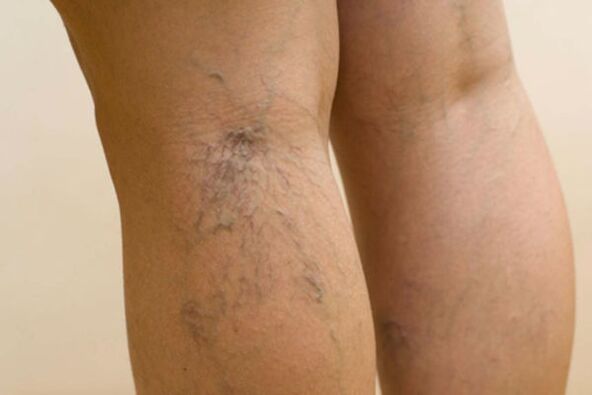 varicose veins in women's legs