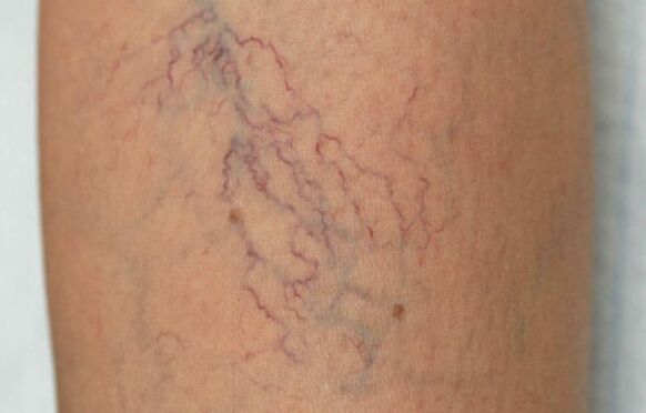 varicose veins on the legs in women