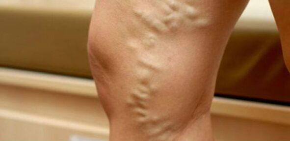 varicose veins on the legs of women