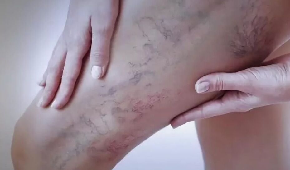 Stars on the legs with varicose veins