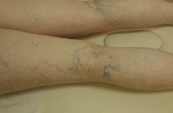 Varicose stars on the legs