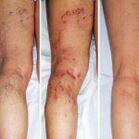 Varicose veins of the legs
