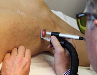 contraindications for the treatment of varicose veins with a laser