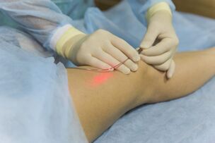 laser treatment of varicose veins the essence of the procedure
