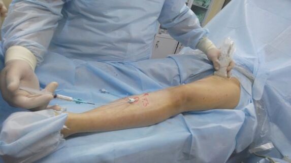 surgery for varicose veins on the legs
