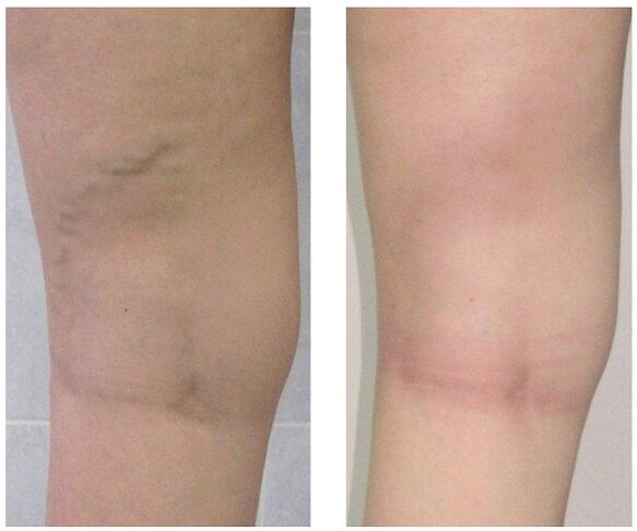 vein in the leg before and after treatment of varicose veins