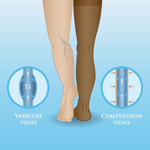 The effect of compression garments on varicose veins in the legs