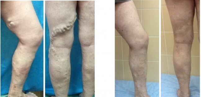 Legs before and after radiofrequency vein obliteration for varicose veins