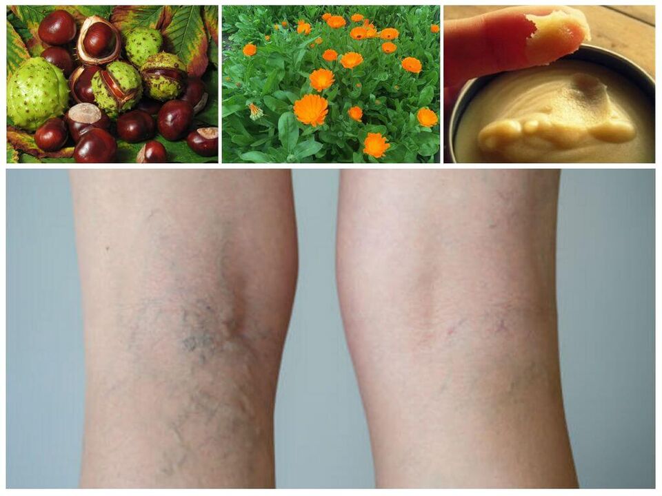varicose veins on the legs and folk remedies for its prevention