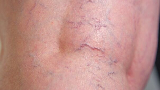 Signs of reticular varicose veins of the lower extremities - dilatation of fine veins and vascular mesh