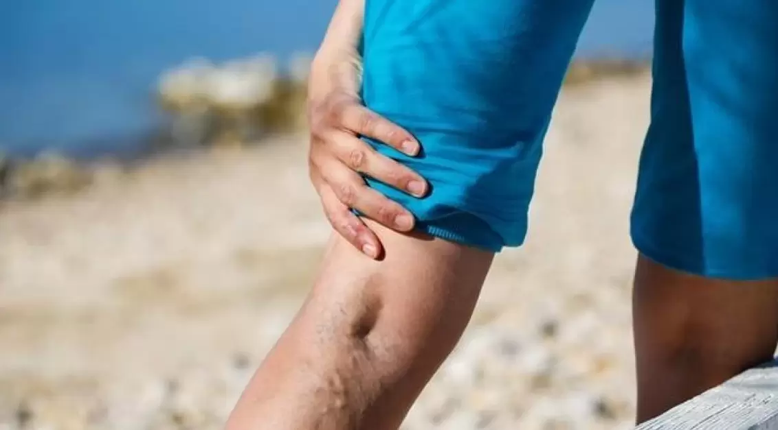 Bulging blue veins on the legs are a sign of varicose veins