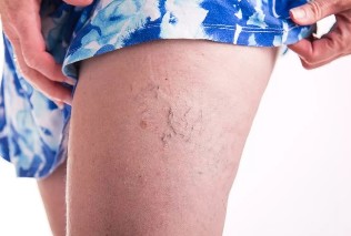 Spider veins on the legs